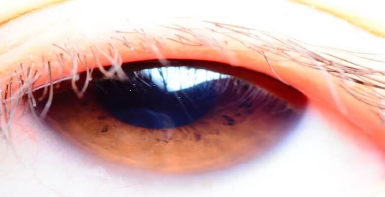 Kirpik Dibi İltihabı (Blefarit) Nedir? Kirpik Dibi İltihabı Belirtileri Nelerdir?