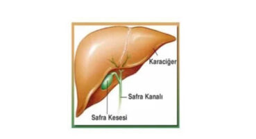 Safra Kesesi Ameliyatı