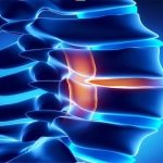 Kanal Darlığı (Lomber Spinal Stenoz): Belirtiler, Tedavi ve Ameliyat Yöntemleri